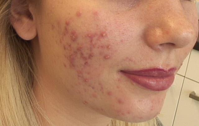Sarah's acne before treatment