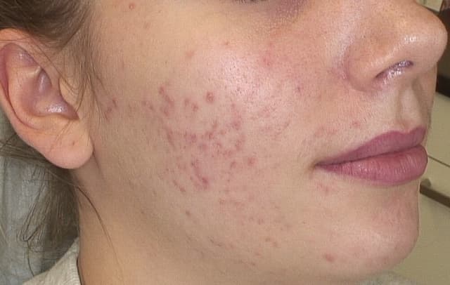 Sarah's progress after 1.5 months