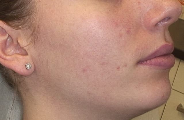 Sarah's clear skin after 3 months